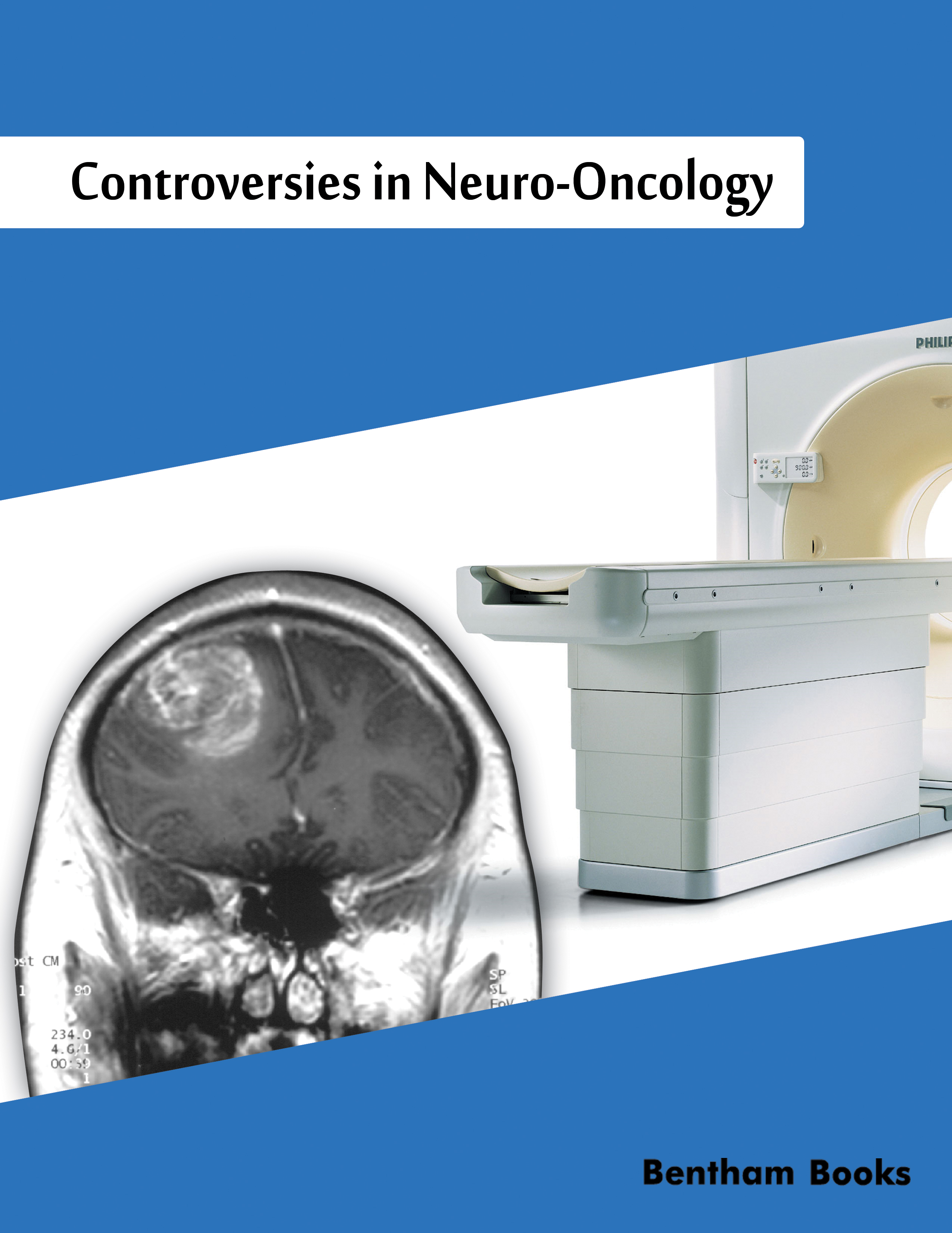 Controversies in Neuro-Oncology